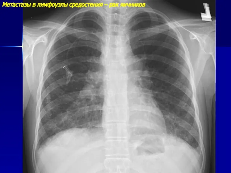 Метастазы в лимфоузлы средостения – рак яичников