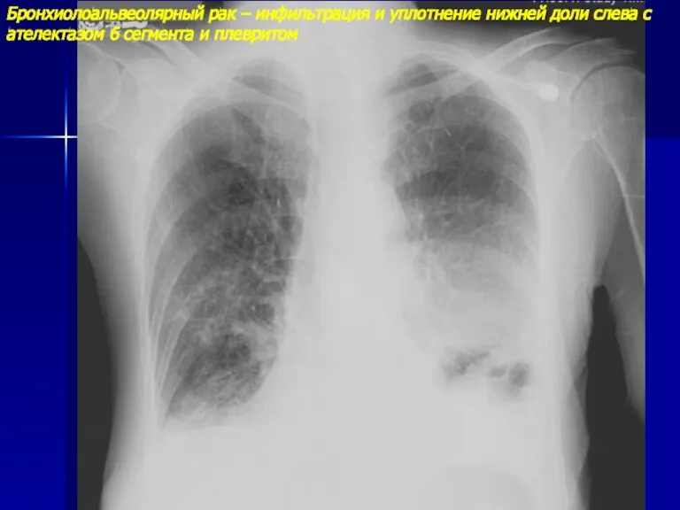 Бронхиолоальвеолярный рак – инфильтрация и уплотнение нижней доли слева с ателектазом 6 сегмента и плевритом