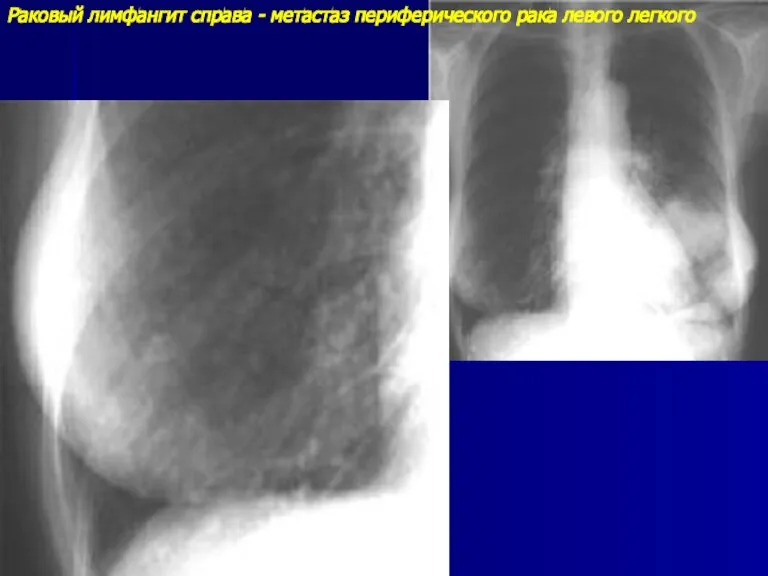 Раковый лимфангит справа - метастаз периферического рака левого легкого