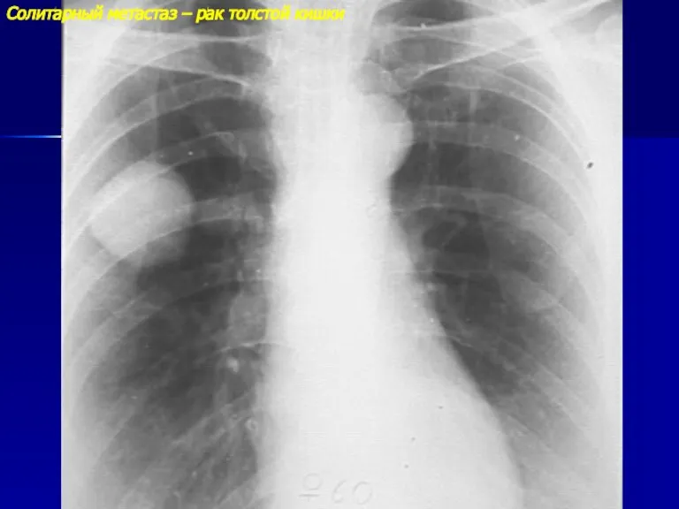 Солитарный метастаз – рак толстой кишки