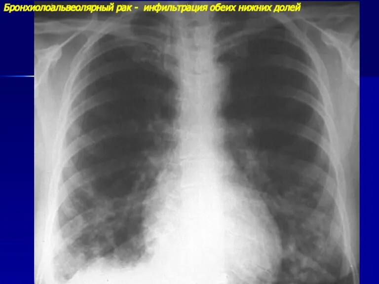 Бронхиолоальвеолярный рак - инфильтрация обеих нижних долей