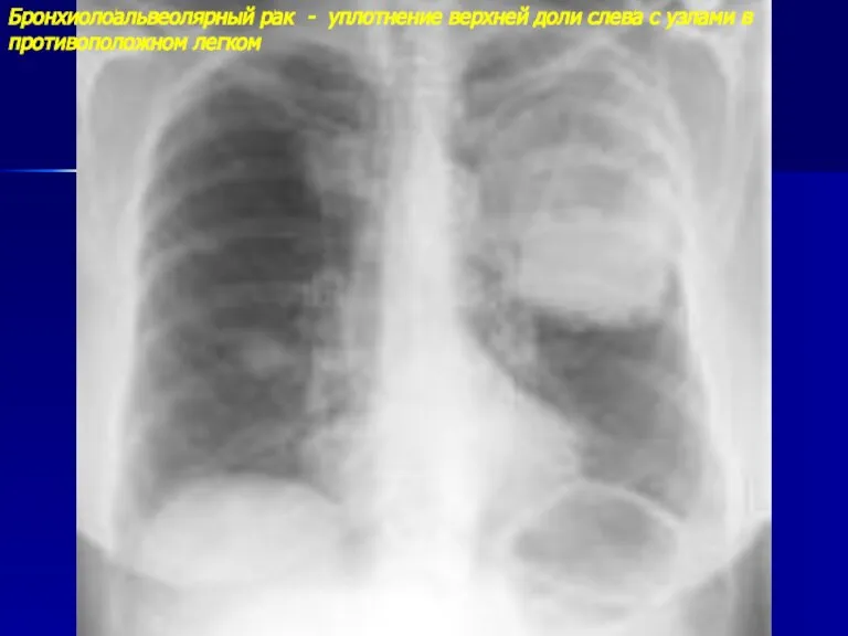 Бронхиолоальвеолярный рак - уплотнение верхней доли слева с узлами в противоположном легком