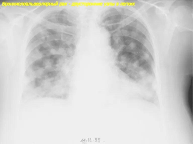 Бронхиолоальвеолярный рак - двусторонние узлы в легких