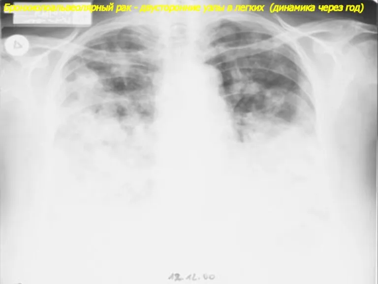 Бронхиолоальвеолярный рак - двусторонние узлы в легких (динамика через год)