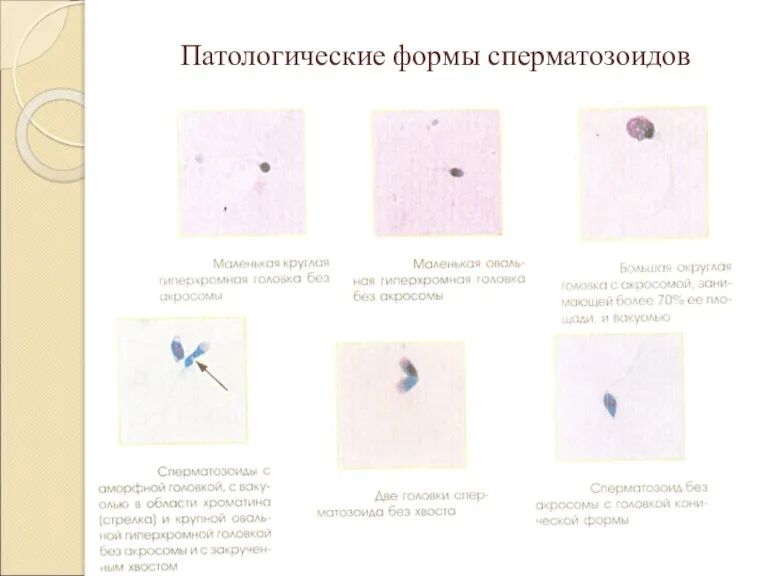 Патологические формы сперматозоидов