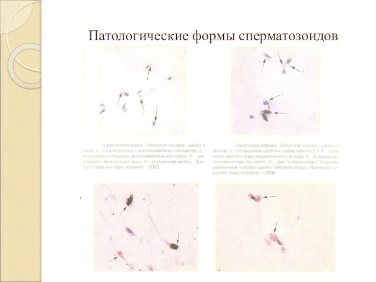 Патологические формы сперматозоидов