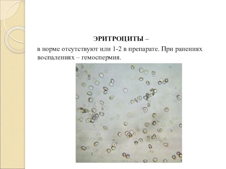 ЭРИТРОЦИТЫ – в норме отсутствуют или 1-2 в препарате. При ранениях воспалениях – гемоспермия.