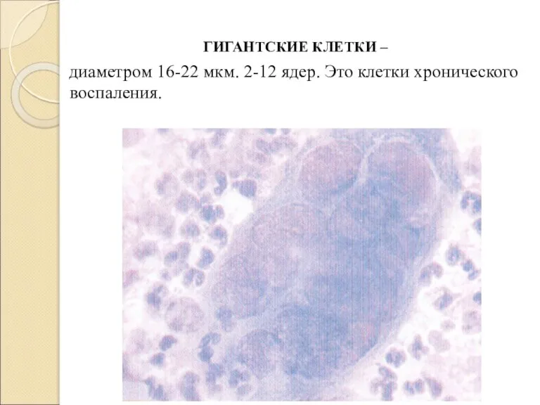 ГИГАНТСКИЕ КЛЕТКИ – диаметром 16-22 мкм. 2-12 ядер. Это клетки хронического воспаления.