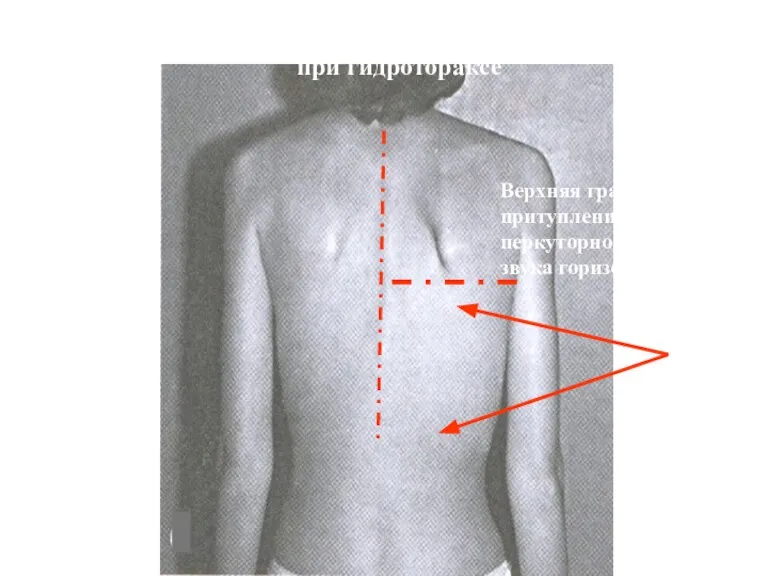 Выбухание пораженной половины грудной клетки при гидротораксе Верхняя граница притупления перкуторного звука горизонтальная