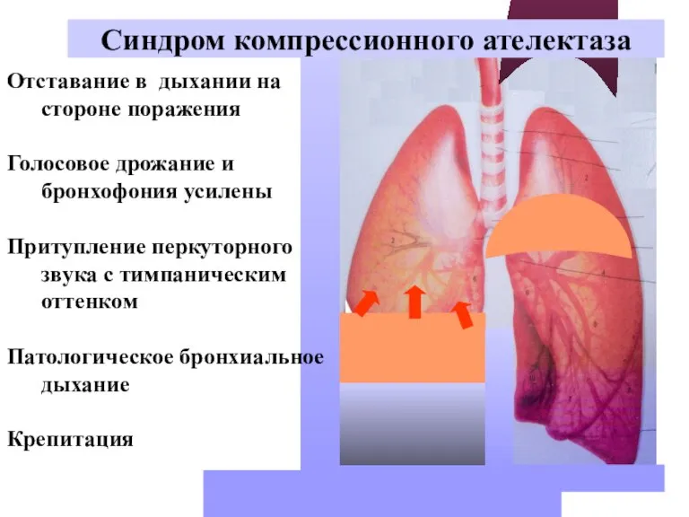 Синдром компрессионного ателектаза Отставание в дыхании на стороне поражения Голосовое дрожание и