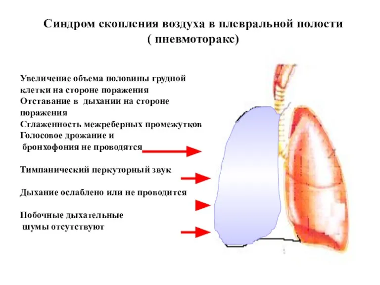 Синдром скопления воздуха в плевральной полости ( пневмоторакс) Увеличение объема половины грудной