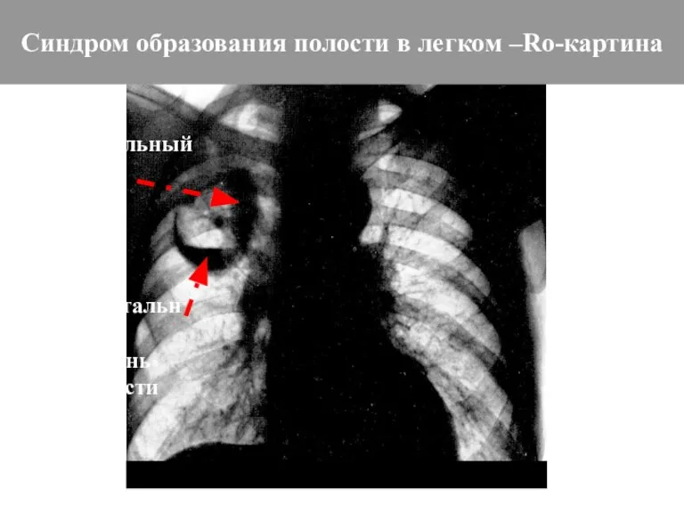 Синдром образования полости в легком –Ro-картина Воспалительный вал Горизонтальный уровень жидкости