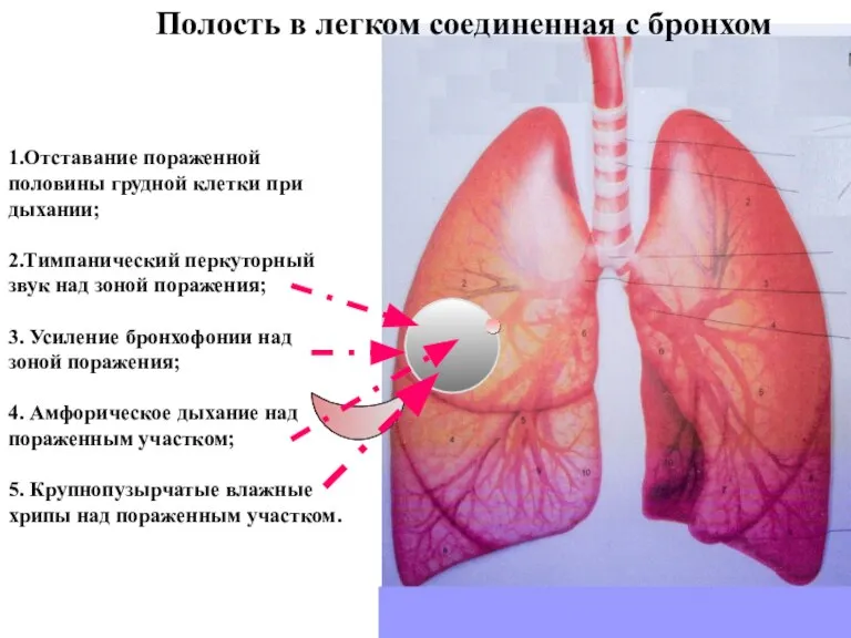 Полость в легком соединенная с бронхом 1.Отставание пораженной половины грудной клетки при