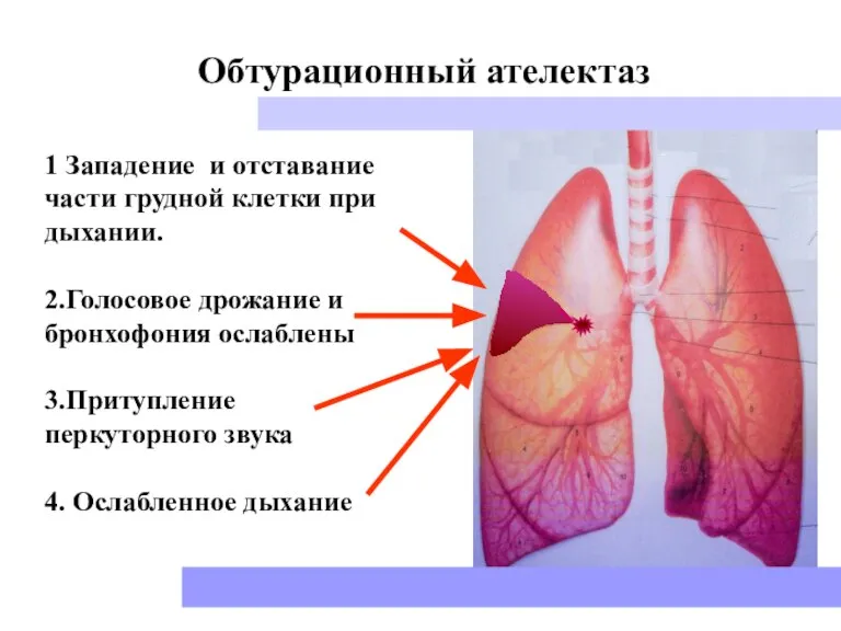 1 Западение и отставание части грудной клетки при дыхании. 2.Голосовое дрожание и
