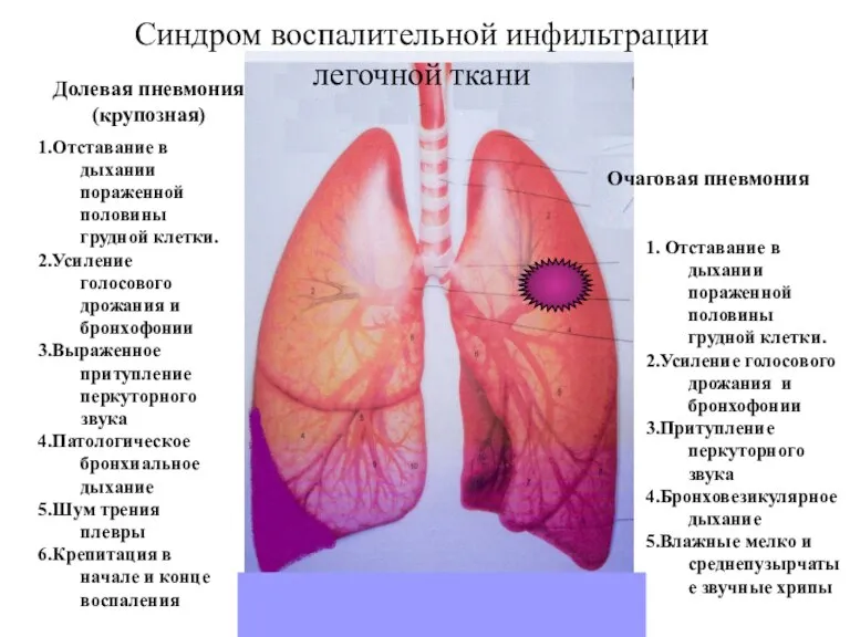 Синдром воспалительной инфильтрации легочной ткани 1.Отставание в дыхании пораженной половины грудной клетки.