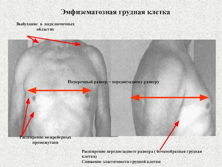 Эмфизематозная грудная клетка Выбухание в надключичных областях Расширение межреберных промежутков Расширение переднезаднего