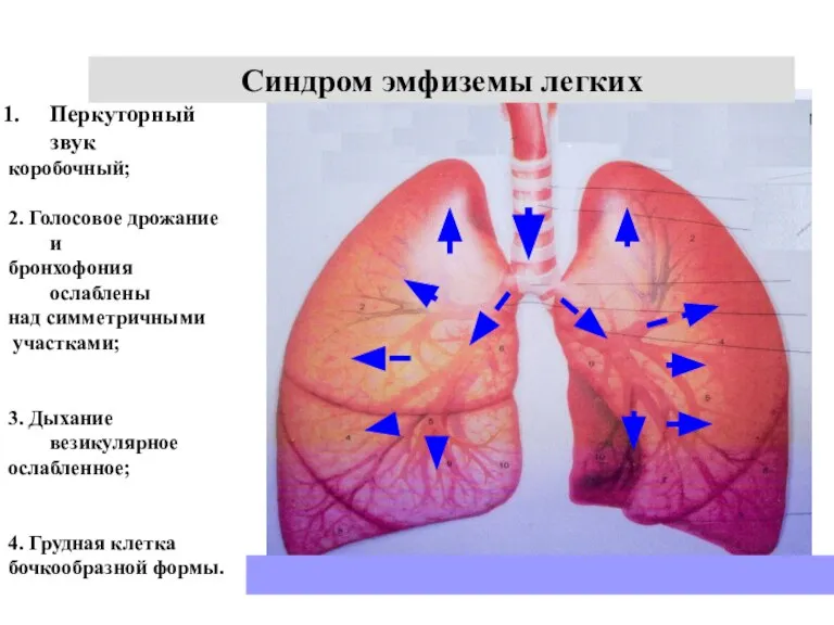 Синдром эмфиземы легких Перкуторный звук коробочный; 2. Голосовое дрожание и бронхофония ослаблены