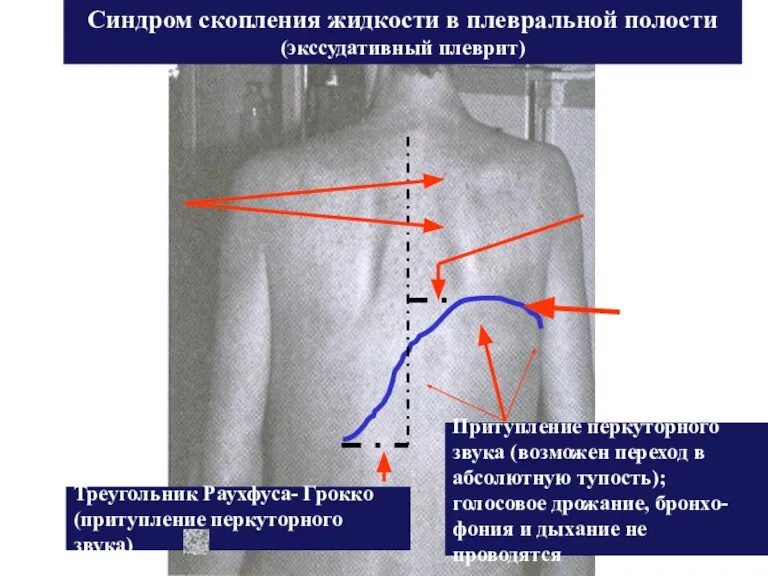 Синдром скопления жидкости в плевральной полости (экссудативный плеврит) Линия Демуазо Треугольник Гарленда