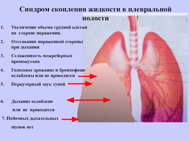 Увеличение объема грудной клетки на стороне поражения. Отставание пораженной стороны при дыхании