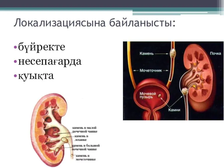 Локализациясына байланысты: бүйректе несепағарда қуықта