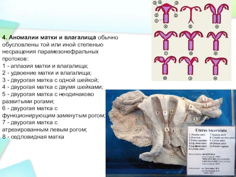 4. Аномалии матки и влагалища обычно обусловлены той или иной степенью несращения