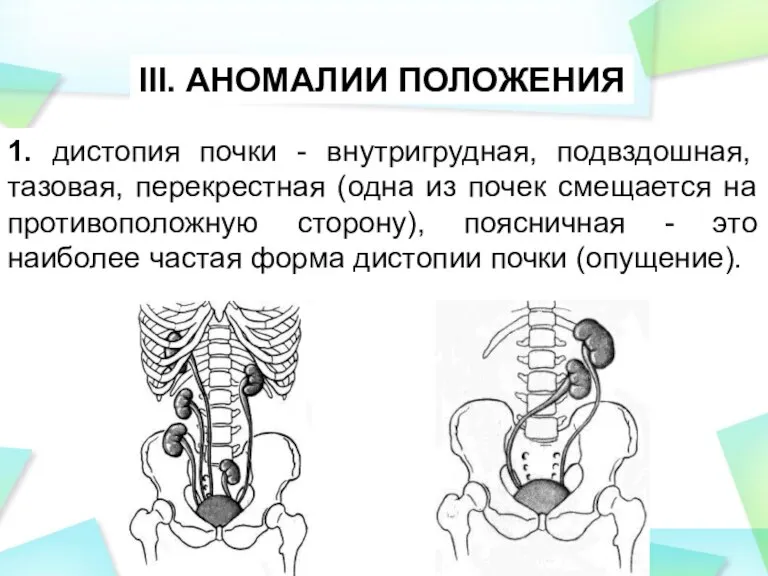 1. дистопия почки - внутригрудная, подвздошная, тазовая, перекрестная (одна из почек смещается