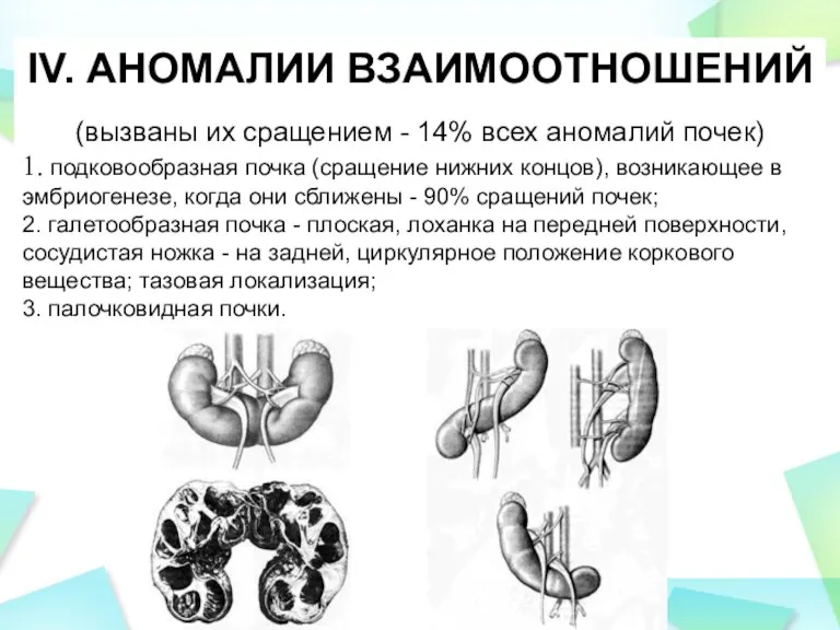 IV. АНОМАЛИИ ВЗАИМООТНОШЕНИЙ (вызваны их сращением - 14% всех аномалий почек) 1.