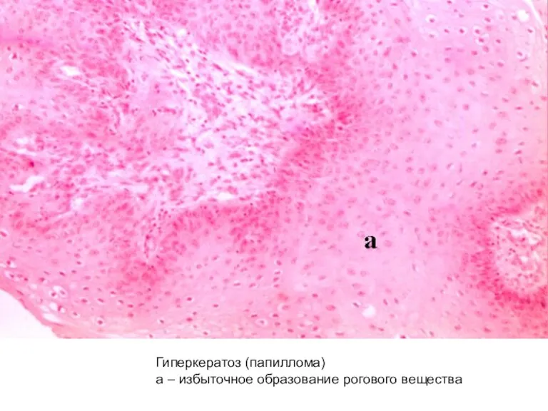 Гиперкератоз (папиллома) а – избыточное образование рогового вещества