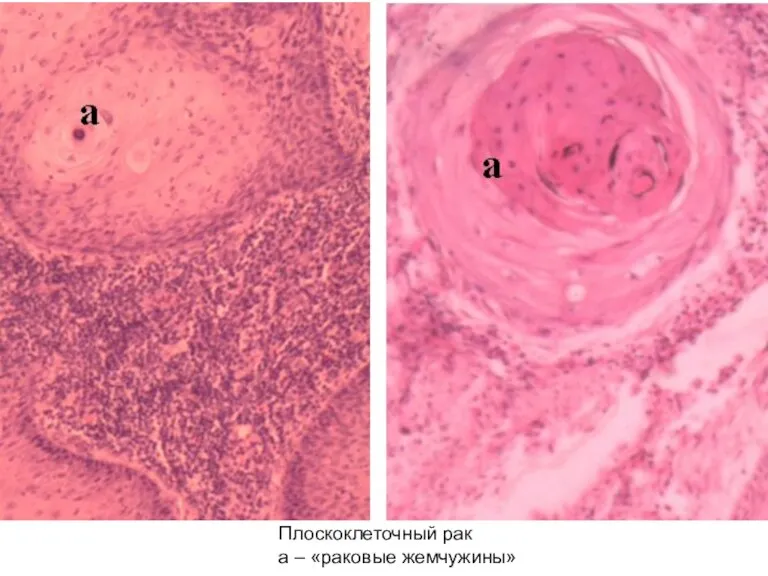 Плоскоклеточный рак а – «раковые жемчужины»