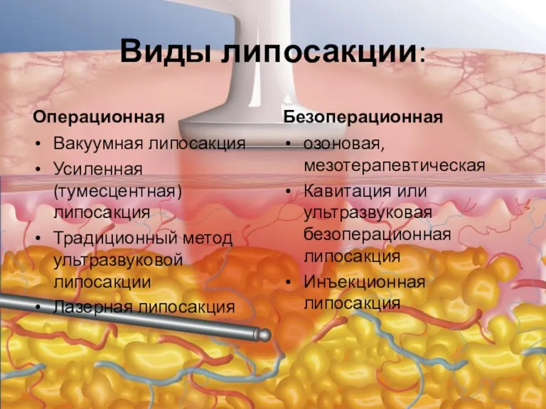 Виды липосакции: Операционная Вакуумная липосакция Усиленная (тумесцентная) липосакция Традиционный метод ультразвуковой липосакции