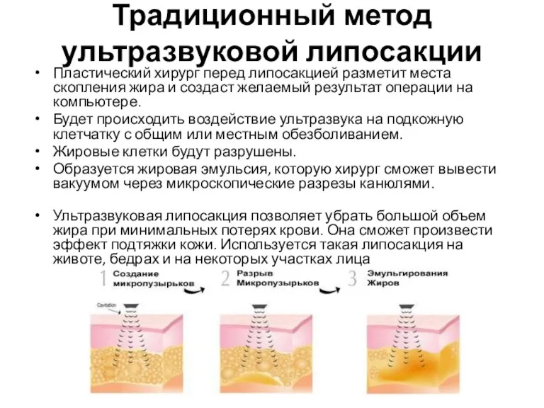 Традиционный метод ультразвуковой липосакции Пластический хирург перед липосакцией разметит места скопления жира