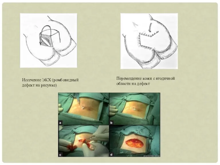 Иссечение ЭКХ (ромбовидный дефект на рисунке) Перемещение кожи с ягодичной области на дефект