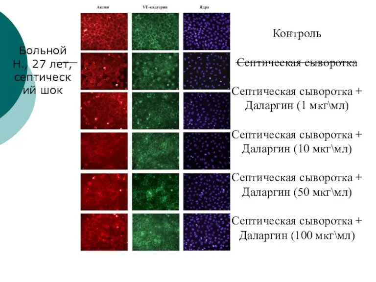 Больной Н., 27 лет, септический шок Контроль Септическая сыворотка Септическая сыворотка +