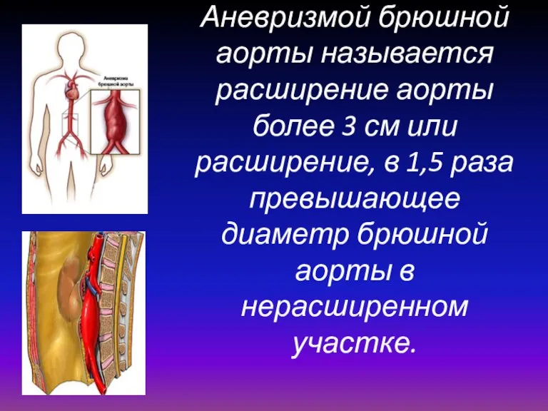 Аневризмой брюшной аорты называется расширение аорты более 3 см или расширение, в