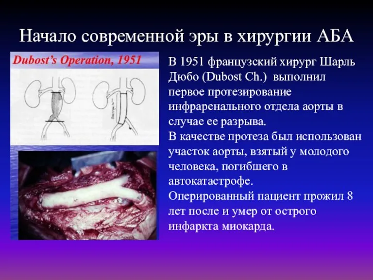 Начало современной эры в хирургии АБА В 1951 французский хирург Шарль Дюбо