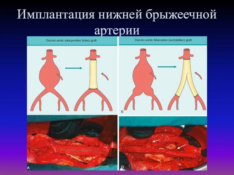 Имплантация нижней брыжеечной артерии