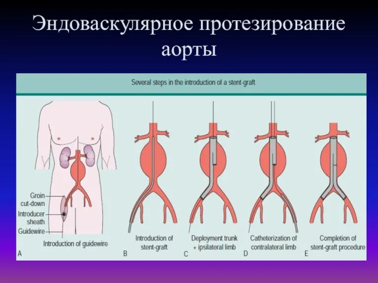 Эндоваскулярное протезирование аорты