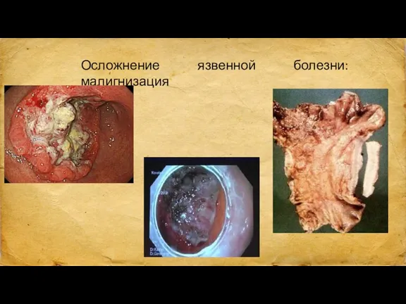 Осложнение язвенной болезни: малигнизация