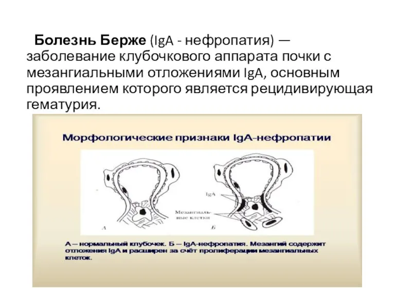 Болезнь Берже (IgA - нефропатия) — заболевание клубочкового аппарата почки с мезангиальными