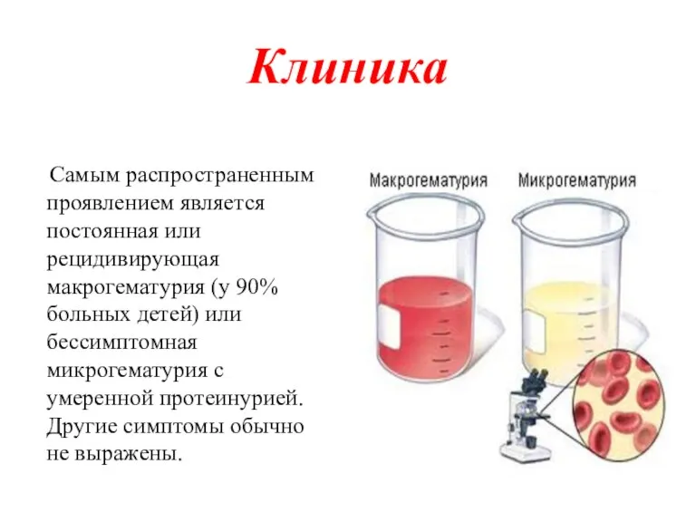 Клиника Самым распространенным проявлением является постоянная или рецидивирующая макрогематурия (у 90% больных