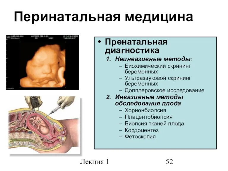 Лекция 1 Перинатальная медицина Пренатальная диагностика Неинвазивные методы: Биохимический скрининг беременных Ультразвуковой