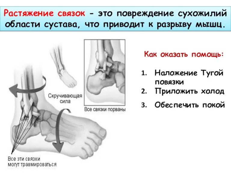 Растяжение связок - это повреждение сухожилий области сустава, что приводит к разрыву