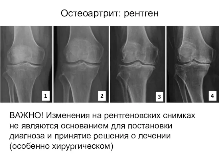 Остеоартрит: рентген ВАЖНО! Изменения на рентгеновских снимках не являются основанием для постановки