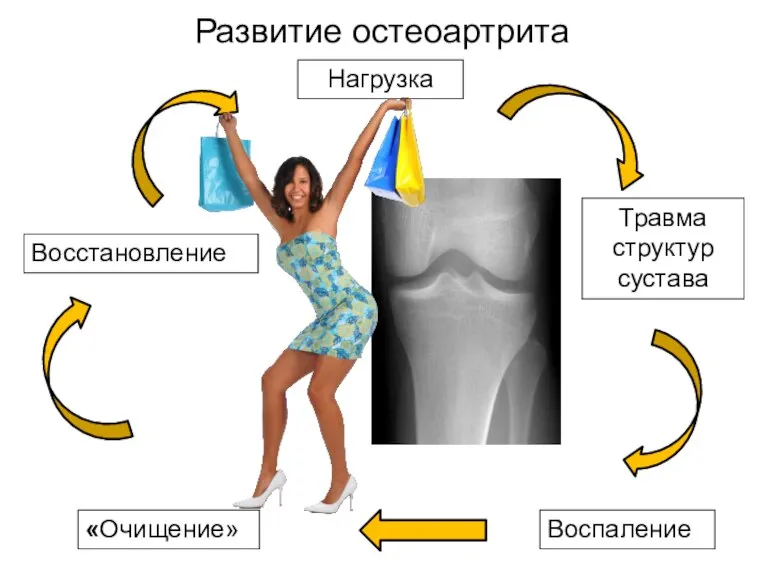 Развитие остеоартрита Воспаление «Очищение» Травма структур сустава Восстановление Нагрузка
