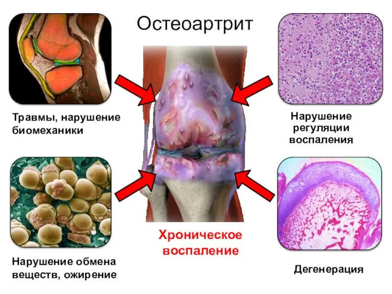 Остеоартрит Травмы, нарушение биомеханики Нарушение обмена веществ, ожирение Нарушение регуляции воспаления Дегенерация Хроническое воспаление