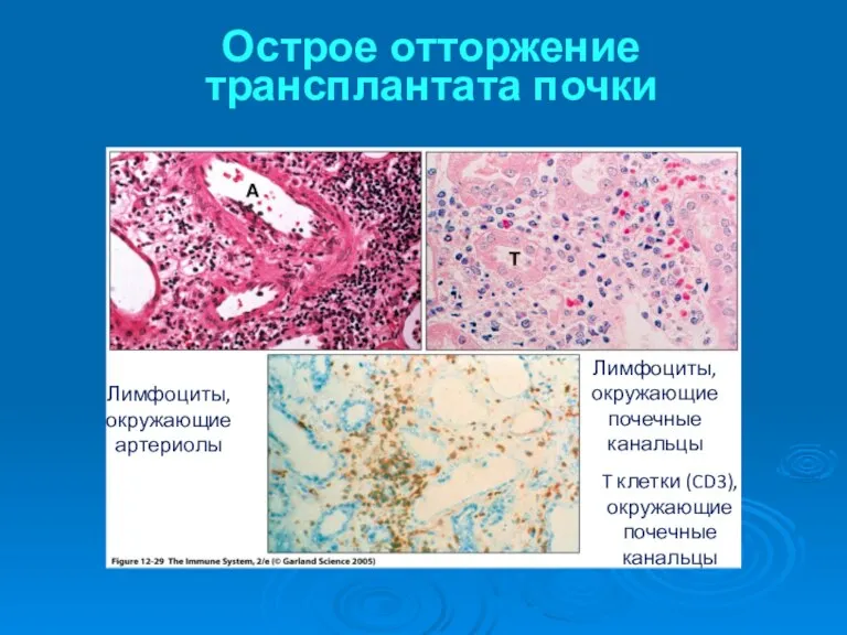 Острое отторжение трансплантата почки T клетки (CD3), окружающие почечные канальцы Лимфоциты, окружающие