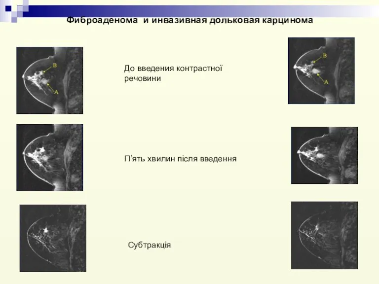 Фиброаденома и инвазивная дольковая карцинома Субтракція П’ять хвилин після введення До введения контрастної речовини