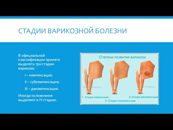 СТАДИИ ВАРИКОЗНОЙ БОЛЕЗНИ В официальной классификации принято выделять три стадии варикоза: I