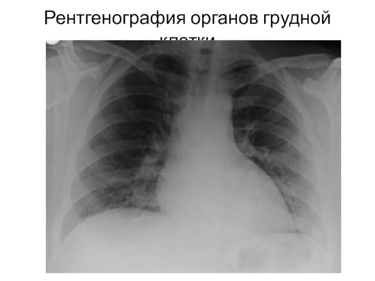 Рентгенография органов грудной клетки