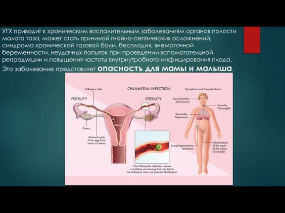 УГХ приводит к хроническим воспалительным заболеваниям органов полости малого таза, может стать